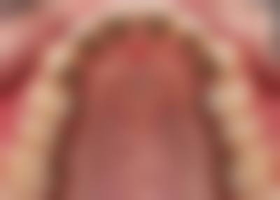 桂林十佳隐适美矫正医院推荐