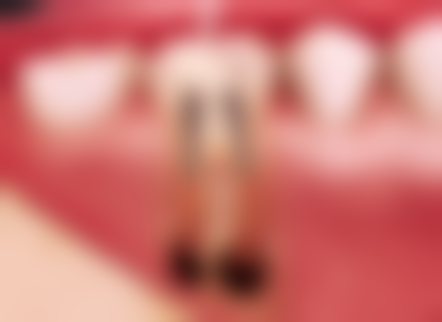 色素附着小黑点的判断与处理