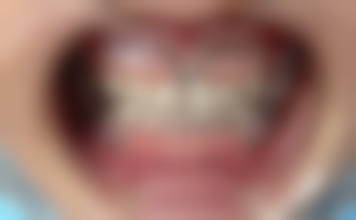 如何提升牙齿美白贴片的成效