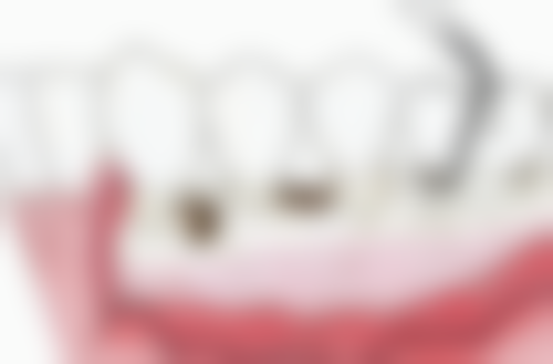 牙齿美白贴片的优势体现