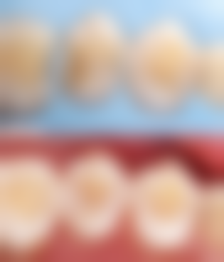 蛀牙补牙时间与治疗方法