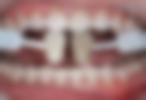 医生技术对烤瓷牙套使用时间的影响