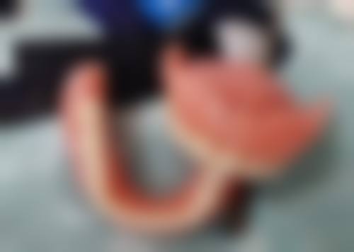 30岁牙齿复杂程度与矫正时间的关系