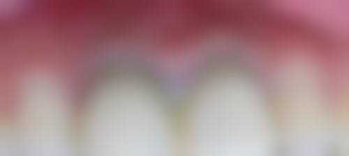 湛江义齿在线咨询24小时，镶牙不用愁！一颗牙800 - 20000元，全口2万 - 20万任你选！ 