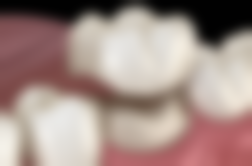 拔牙后第三天能吃什么？软烂食物、流食如粥和牛奶等或是不错选择 