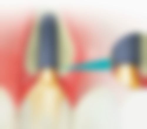 推荐医院处理拔牙后一直出血的口碑评价和真人实例