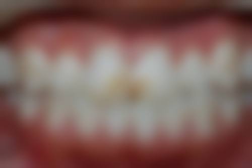 [医院名称]的牙冠修复成效