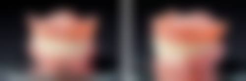 为什么根管治疗要做特别多次：患者的配合与修复