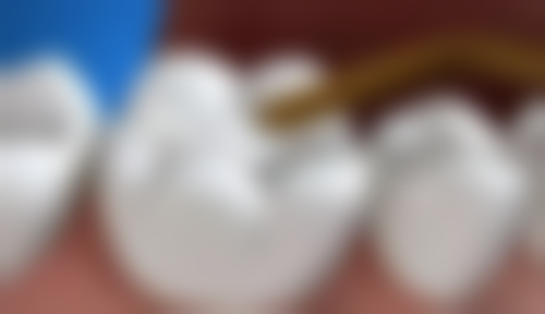 {山东补牙医院24小时在线咨询：临沂健存、可恩等口腔医院可选，青岛可恩3M补牙168元起！ 