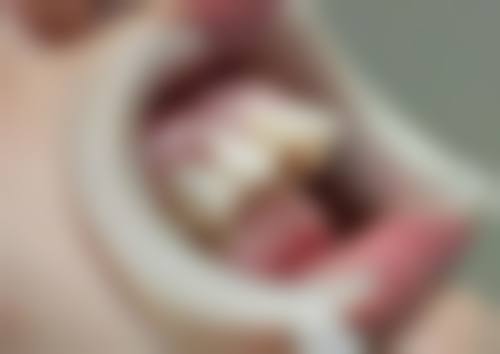 牙齿的根管治疗的根管预备