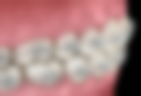 三、北京京大博爱口腔舌侧矫正的优势人群