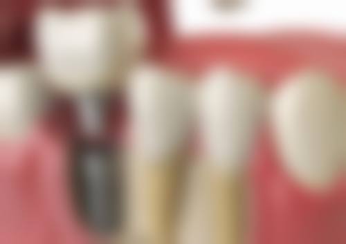 {美奥种植牙怎么样？技术先进、医生靠谱还实惠，单颗2980元起，半口All - on - 4种植牙4万起！ 