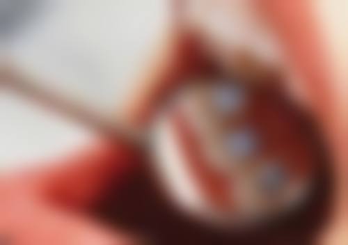 口臭的话洗牙有用吗？北京协和医院洗牙或可改善因牙菌斑、牙结石导致的口臭！ 