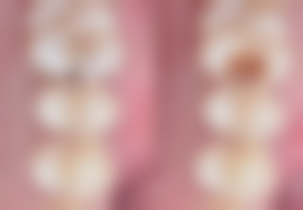 北京协和医院洗牙成效与实例