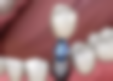 拔牙后不镶牙：除智齿外的牙齿