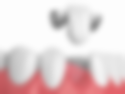 什么叫牙根根管治疗——注意事项