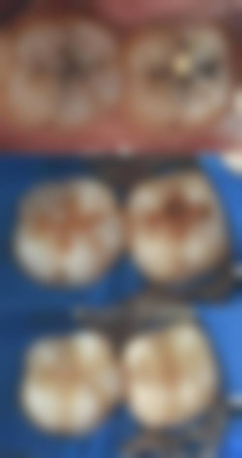 扬州浦美口腔:实惠医生效率高补牙