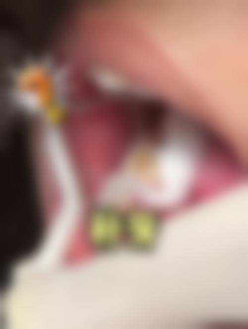 李银林口腔:经验医生擅长补牙