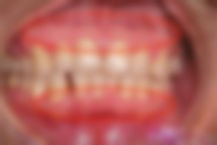 小孩地包天能矫正的技术优势