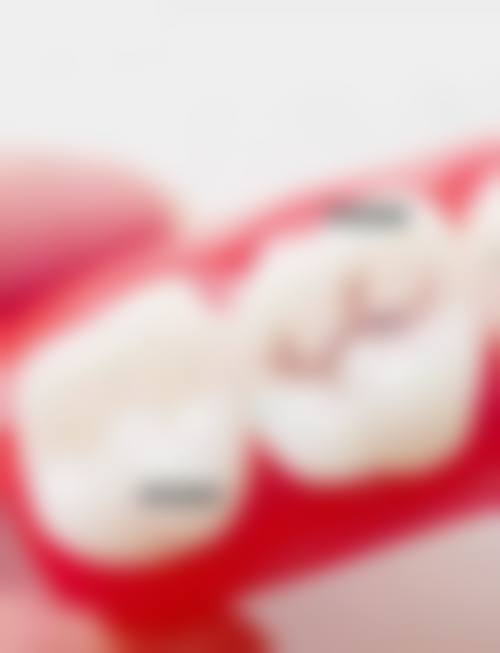 {成都儿牙医院在线咨询24小时，靠谱之选！新桥衣冠庙院区儿童窝沟封闭100元/颗起，正畸也在行！ 