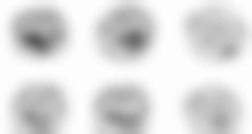 五、嘉善口腔医院全口种植选择建议