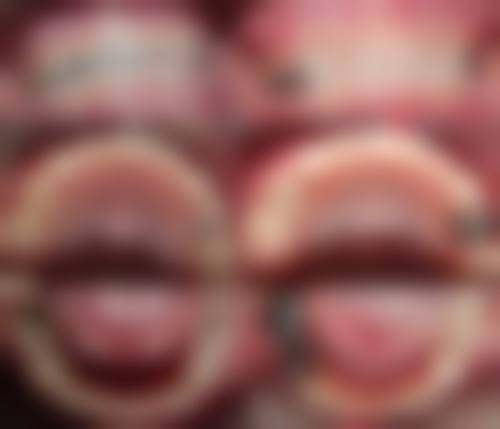 {嘉善全口种植在线咨询24小时！嘉齿口腔全口吸附性义齿1.2万起，博厚口腔瑞士ITI种植体8800元/颗 