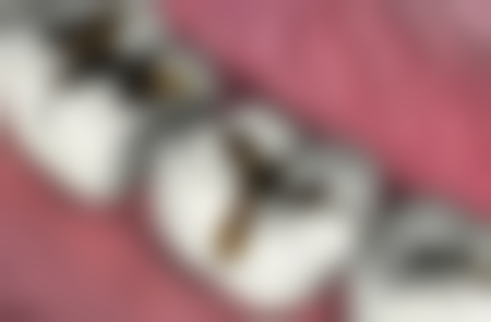 十四周岁的孩子可以补牙吗？北京大学口腔医院补牙效果好、收费合理值得选择！ 