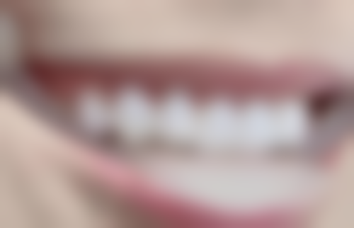 补牙绿色的是什么材料？或与银汞合金使用、牙齿龋坏及材料残留有关