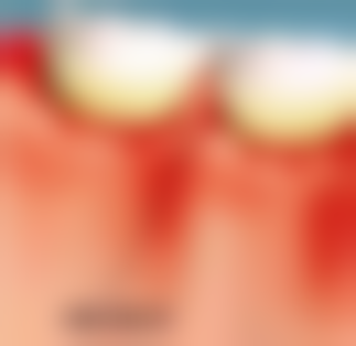 如何预防根管治疗后牙齿松动