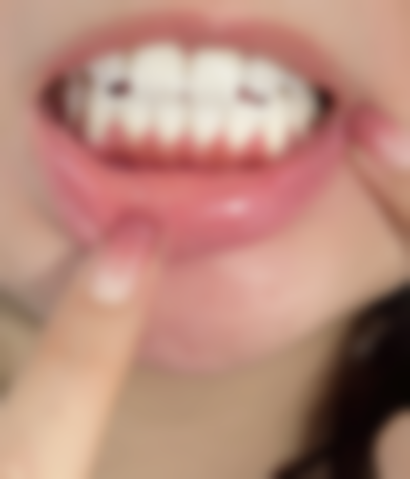 牙齿美白后定期复查的注意事项