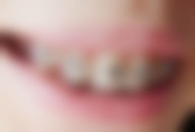 杭州优梨口腔门诊真实实例