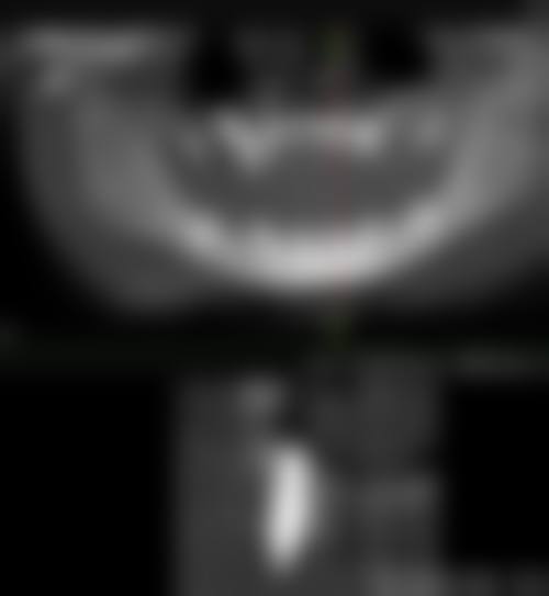 {达州半口种植医院在线咨询24小时！绮云口腔半口种植2万起，单颗2980元起超划算！ 