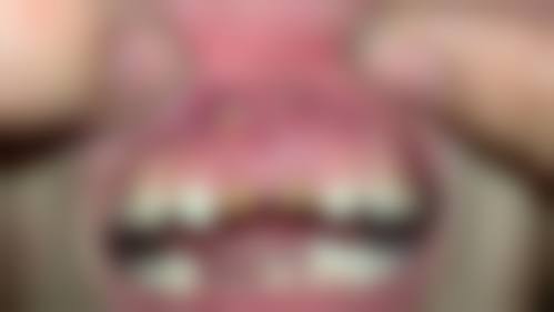 濮阳儿牙在线咨询24小时，三甲医院专业医生接诊，可问诊根尖炎、根管治疗等儿童牙疾