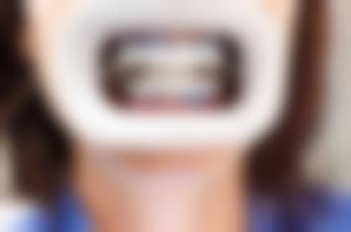 揭阳牙齿美白医生24小时在线咨询，深夜咨询后终于找到适合我的美白方案