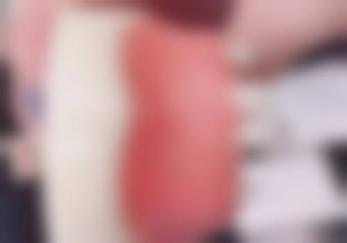 技术亮点：3D导板种植技术揭秘