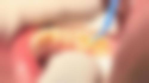 咸阳金属矫正在线咨询24小时，二甲公立医保定点医院可约，金属托槽矫正4000-6000元