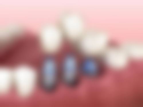 六院骨干医生：专精修复解决牙齿难题