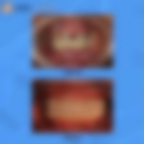 全瓷冠修复：美观与实用的理想结合