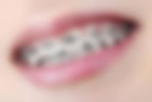 全瓷牙能保持多长时间——生活习惯的影响