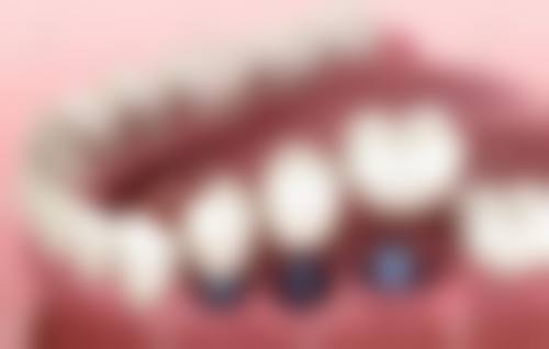 咸宁种植牙医生在线询问24小时——就诊攻略总结