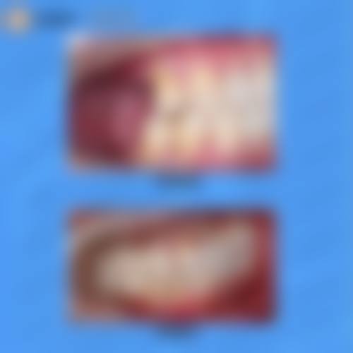 汕尾种植牙医生24小时在线询问之更终决策