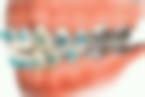 矫正牙齿只矫正上排的实例分析