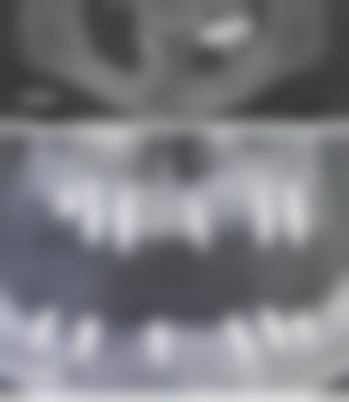 种植项目：低价优质的牙齿重生之选