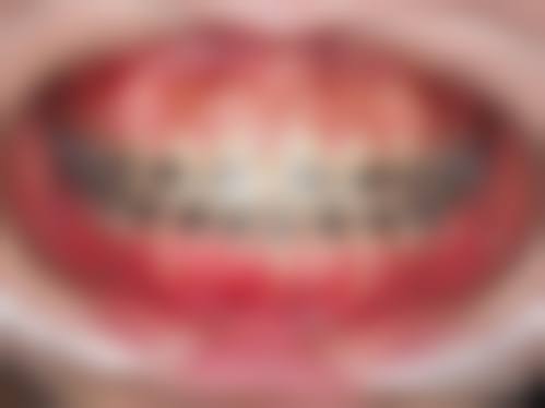 运城牙齿矫正医生24小时在线询问：对比矫正方案