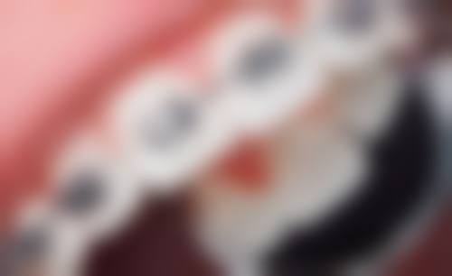 {丹东金属矫正医生在线咨询24小时，亲测分享丹东正畸靠谱医生与口碑医院全攻略