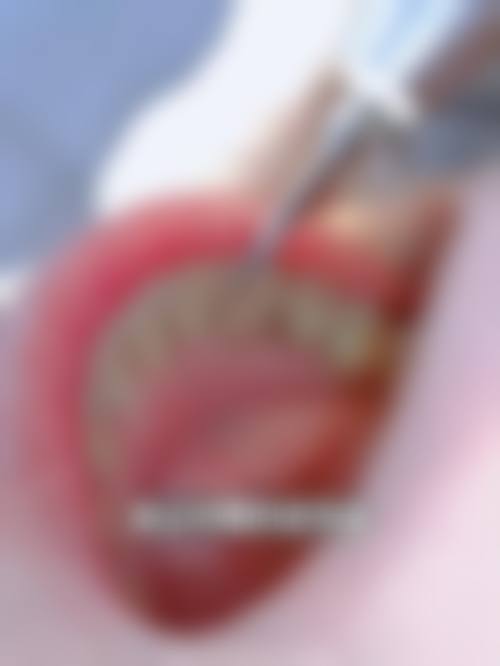 三、价格实惠：1580元起种牙性价比高