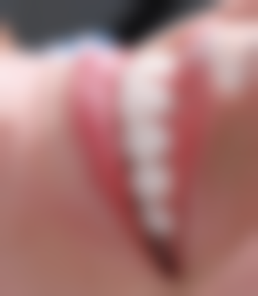 沧州半口种植技术优势：即刻负重微创省心