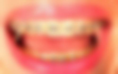 金属矫正技术与优势解读