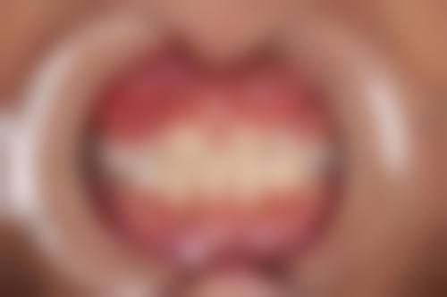 年龄阶段对矫正价格的影响