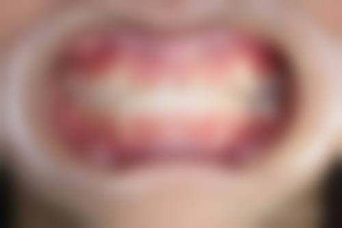 宝宝地包天怎么辨认？可从牙齿咬合、下颌前突、面部对称等特征来判断！ 